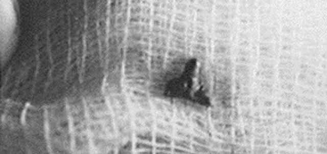 Surgeon Roger Leir And His Study Of Mysterious Alien Implants 4 51080880 1