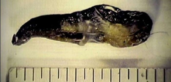 Surgeon Roger Leir And His Study Of Mysterious Alien Implants 5 69489458