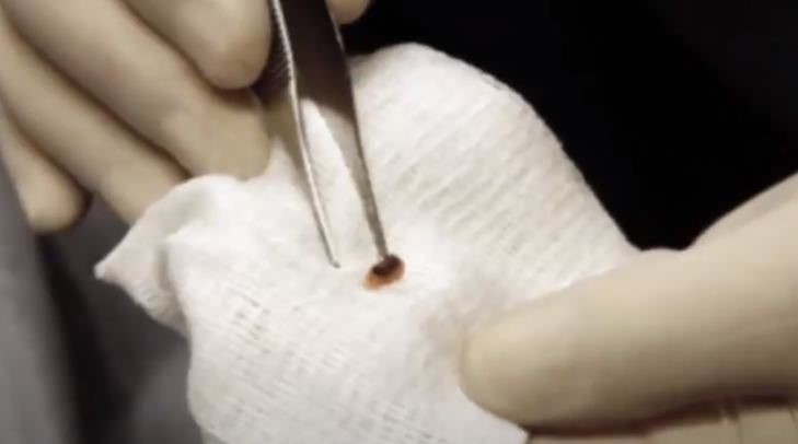 Surgeon Roger Leir And His Study Of Mysterious Alien Implants 3 Surgeon Roger Leir And His Study Of Mysterious Alien Implants