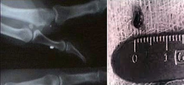 Terrifying Alien Abduction Of Tim Cullen: Alien Implant Attached In His Nerves