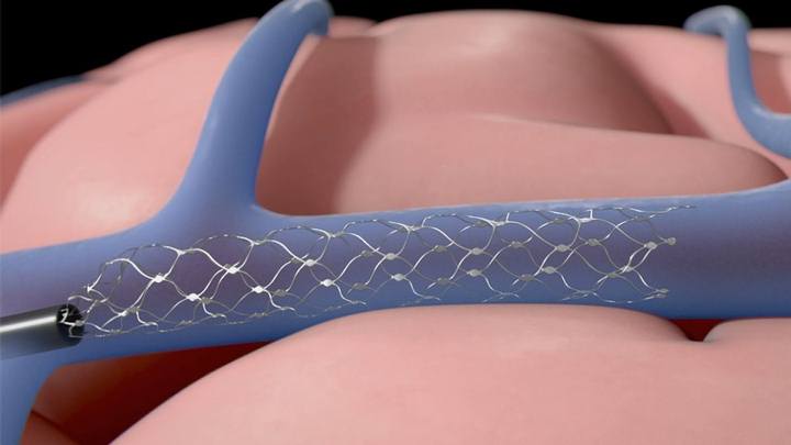 Synchron Will Conduct Human Brain Chip Implants Testing In The United States