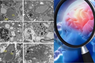 cause of Alzheimer's