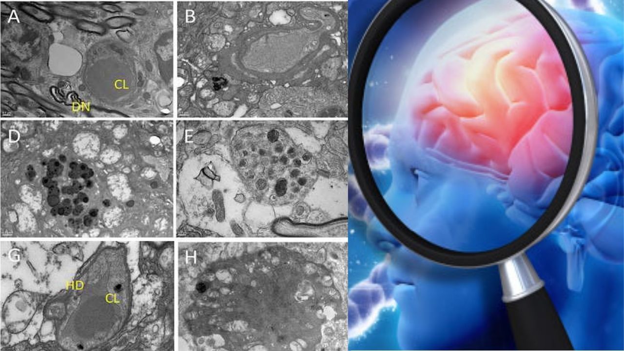 What Causes Alzheimer’s Disease? Scientists May Have Finally  Discovered It