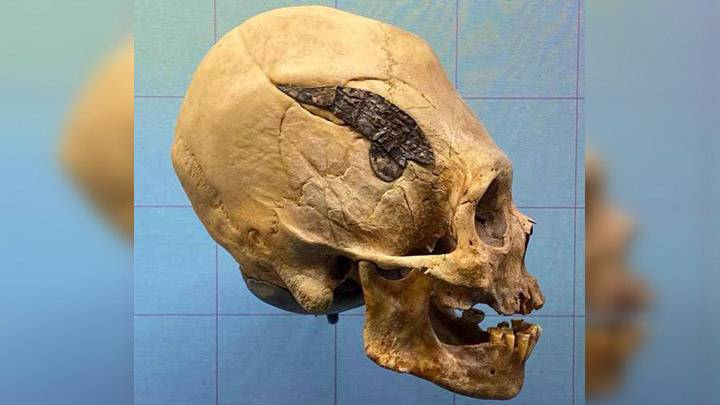 Advanced Surgery In Ancient Times: 2000 Year Old Elongated Skull Joined By Metal Found