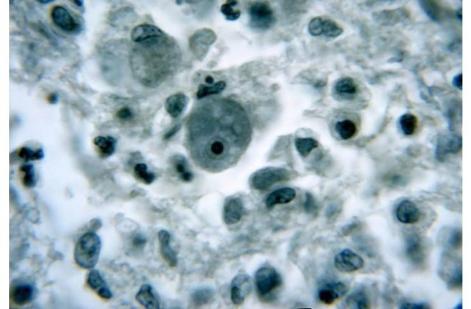 Mind Manipulating Parasites That Feeds On The Human Brains 3 Damage (black cavities) caused by Naegleria Fowleri as seen in a brain tissue sample. Mind Manipulating Parasites
